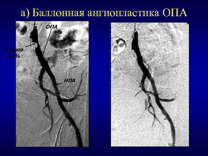 а) Баллонная ангиопластика ОПА Стеноз 95% НПА 