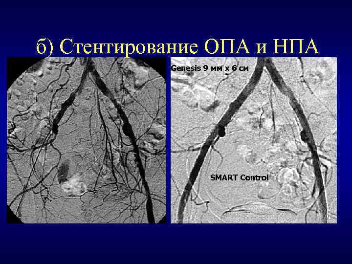б) Стентирование ОПА и НПА Genesis 9 мм х 6 см SMART Control 