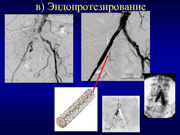 в) Эндопротезирование 