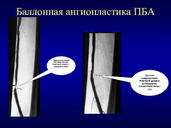 Баллонная ангиопластика ПБА 