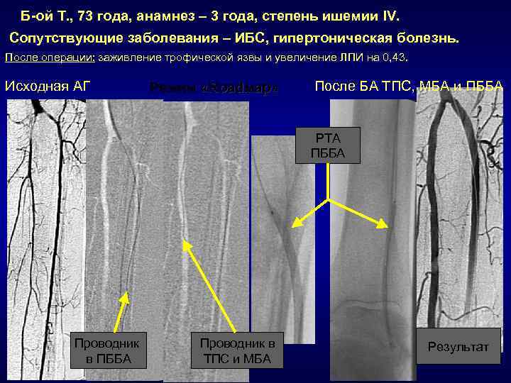 Б-ой Т. , 73 года, анамнез – 3 года, степень ишемии IV. Сопутствующие заболевания