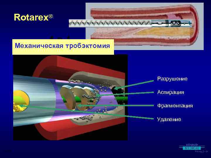 Rotarex® 4 -в-1 Механическая тробэктомия Разрушение Аспирация Фрагментация Удаление V. 0109 