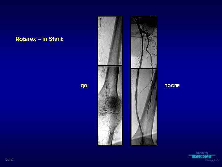 Rotarex – in Stent ДО V. 0109 ПОСЛЕ 