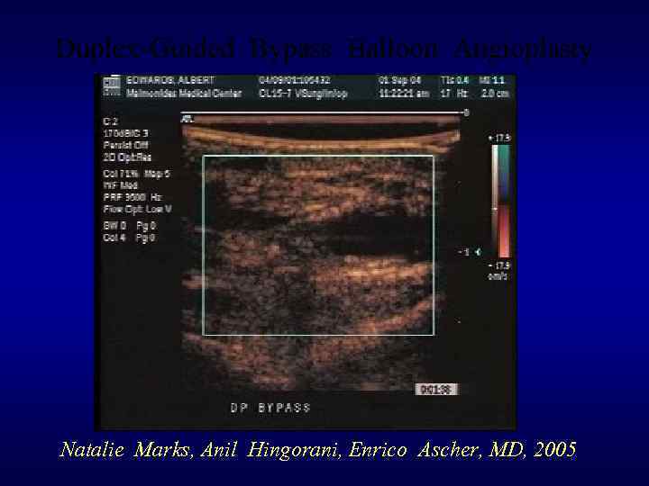 Duplex-Guided Bypass Balloon Angioplasty Natalie Marks, Anil Hingorani, Enrico Ascher, MD, 2005 