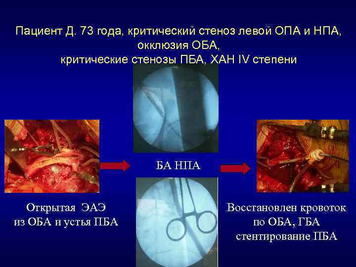 Пациент Д. 73 года, критический стеноз левой ОПА и НПА, окклюзия ОБА, критические стенозы