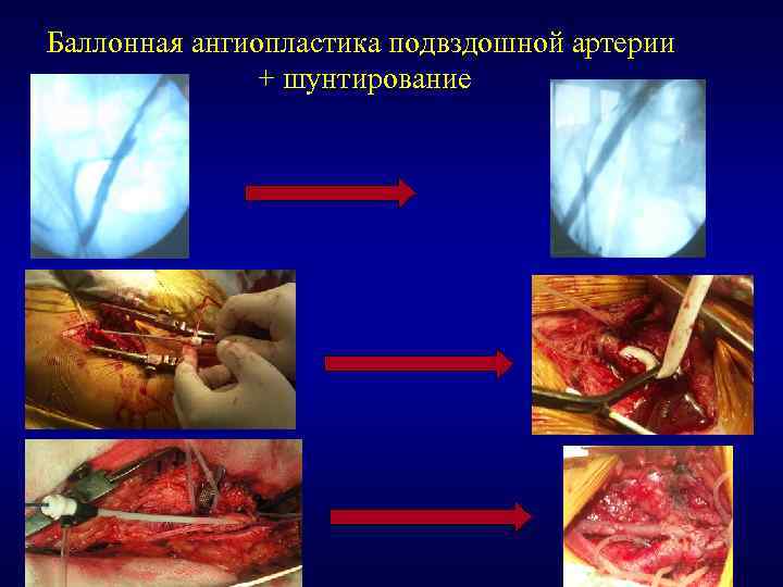 Баллонная ангиопластика подвздошной артерии + шунтирование 