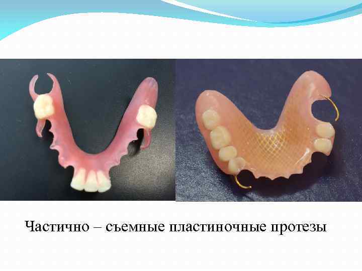 Частично – съемные пластиночные протезы 