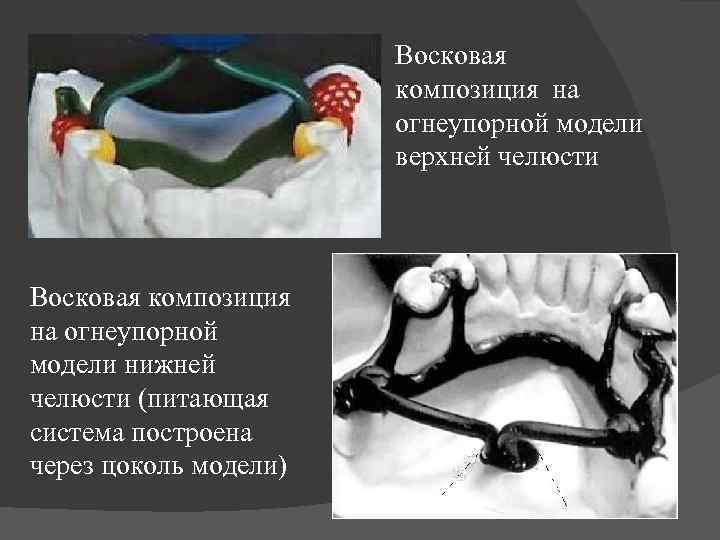 Восковая композиция на огнеупорной модели верхней челюсти Восковая композиция на огнеупорной модели нижней челюсти