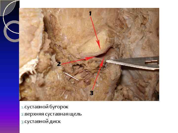 1. суставной бугорок 2. верхняя суставная щель 3. суставной диск 