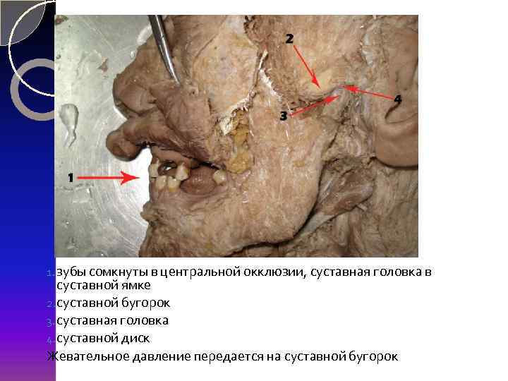 1. зубы сомкнуты в центральной окклюзии, суставная головка в суставной ямке 2. суставной бугорок