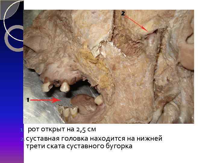 1. рот открыт на 2, 5 см 2. суставная головка находится на нижней трети
