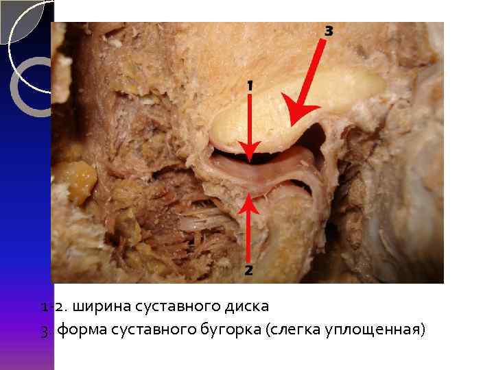 1 -2. ширина суставного диска 3. форма суставного бугорка (слегка уплощенная) 