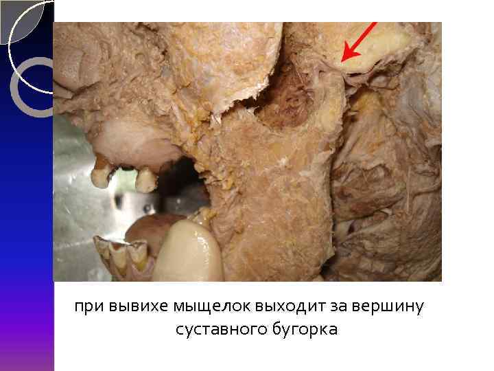 при вывихе мыщелок выходит за вершину суставного бугорка 