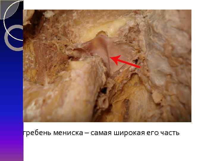 гребень мениска – самая широкая его часть 