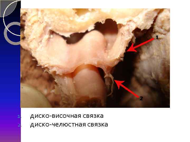 1. 2. диско-височная связка диско-челюстная связка 
