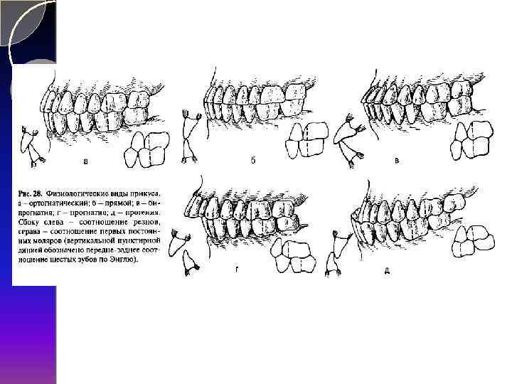 Физиологические виды прикуса. Типы прикусов ортогнатический. Прикус прогнатия и прогения.