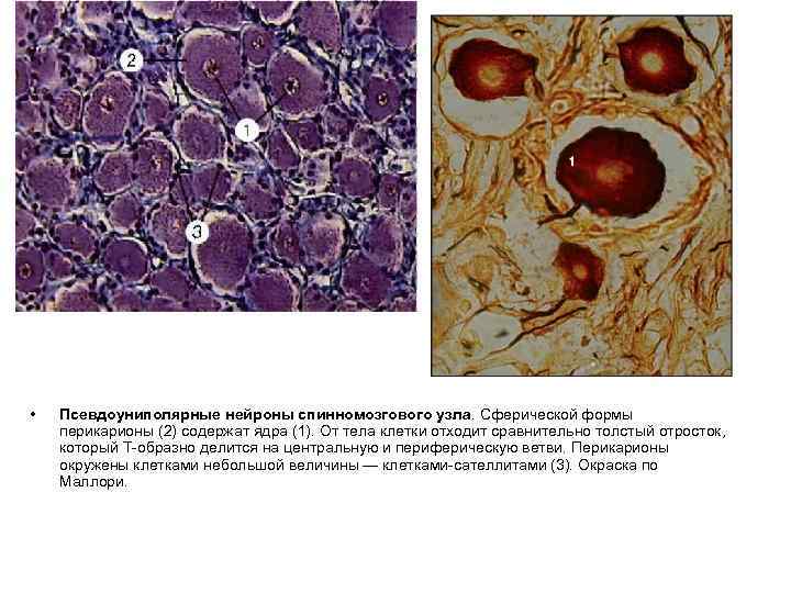  • Псевдоуниполярные нейроны спинномозгового узла. Сферической формы перикарионы (2) содержат ядра (1). От