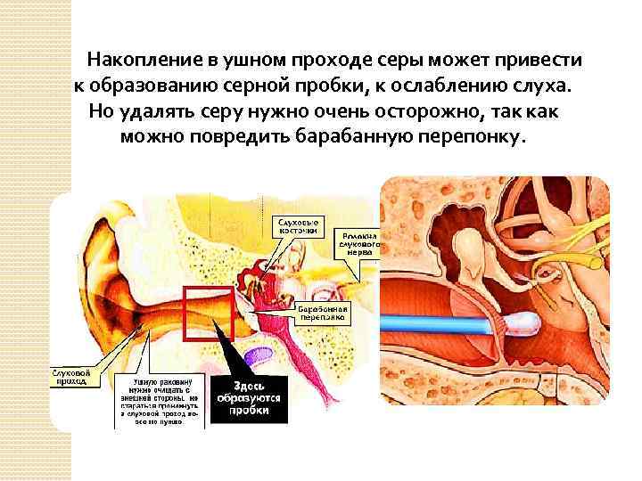  Накопление в ушном проходе серы может привести к образованию серной пробки, к ослаблению