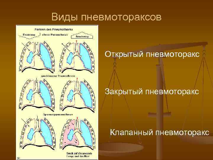 Виды пневмотораксов Открытый пневмоторакс Закрытый пневмоторакс Клапанный пневмоторакс 