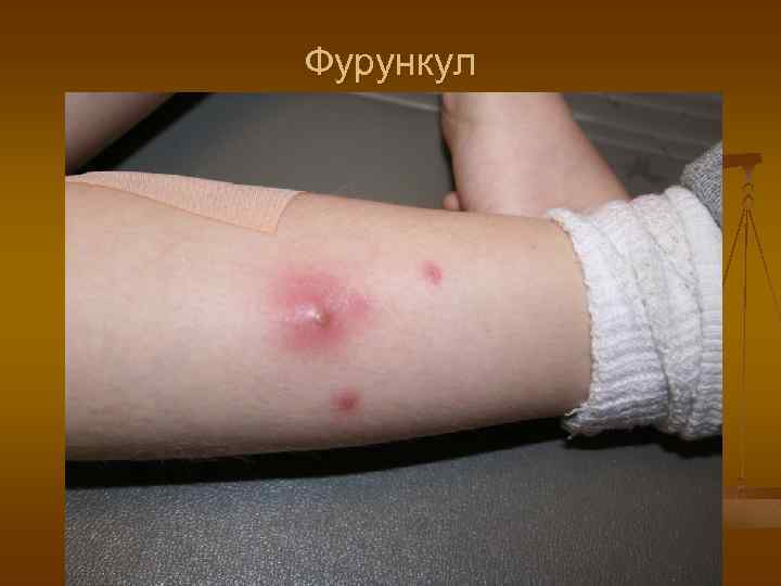 Фурункул 