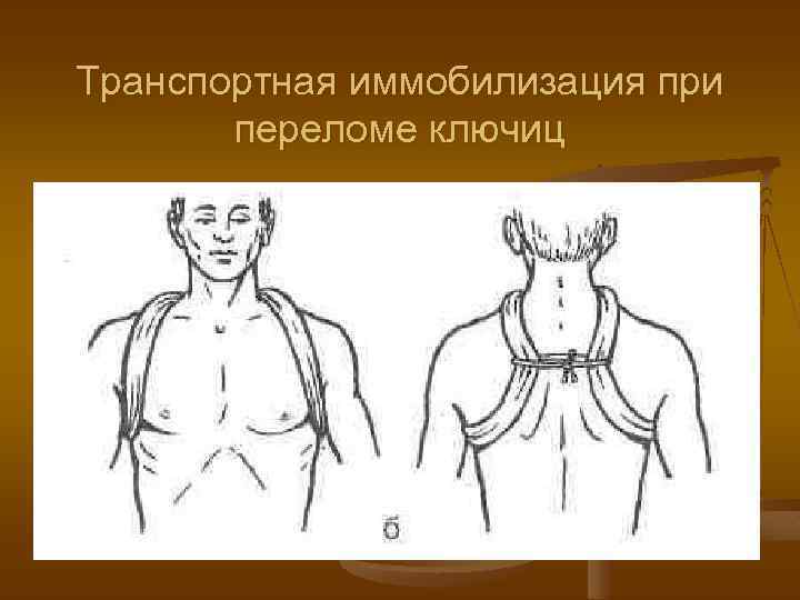 Транспортная иммобилизация при переломе ключиц 