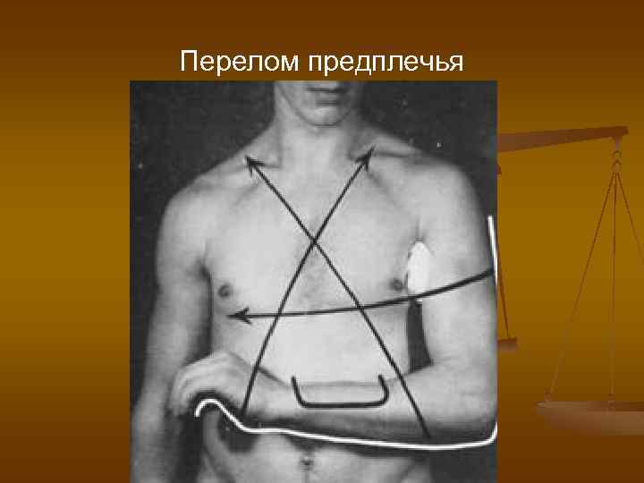 Перелом предплечья 