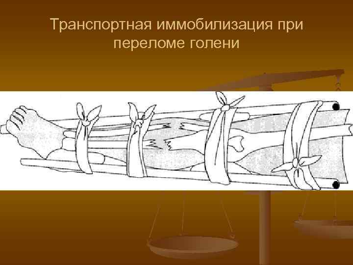 Транспортная иммобилизация при переломе голени 
