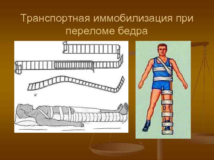 Транспортная иммобилизация при переломе бедра 