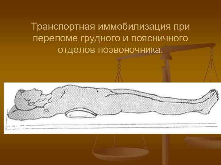 Транспортная иммобилизация при переломе грудного и поясничного отделов позвоночника. 