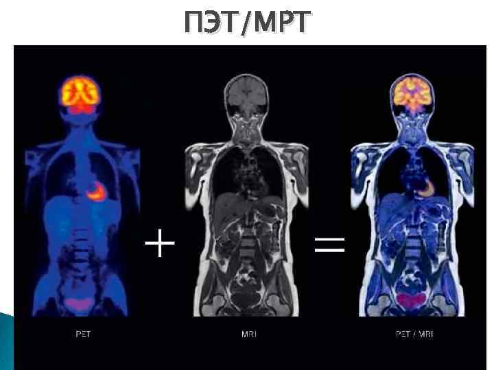 ПЭТ/МРТ 