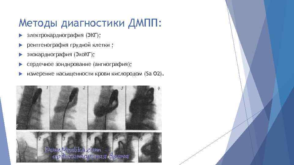 Методы диагностики ДМПП: электрокардиография (ЭКГ); рентгенография грудной клетки ; эхокардиография (Эхо. КГ); сердечное зондирование