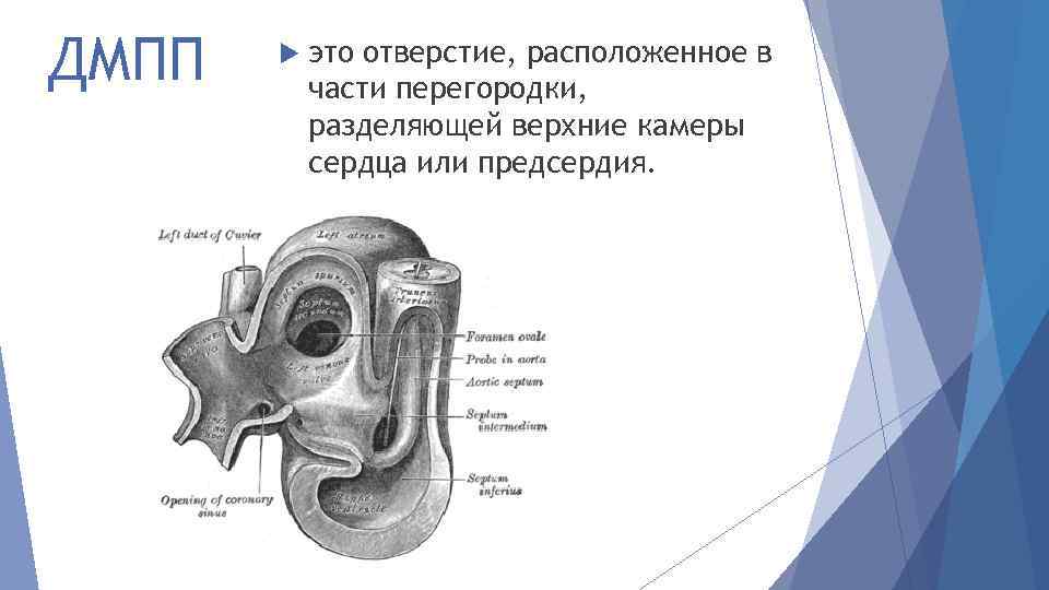 ДМПП это отверстие, расположенное в части перегородки, разделяющей верхние камеры сердца или предсердия. 