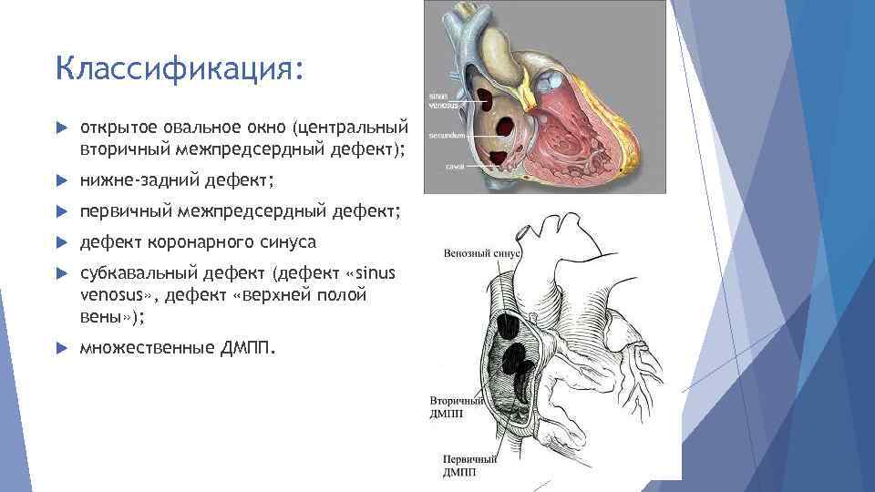 Классификация: открытое овальное окно (центральный вторичный межпредсердный дефект); нижне-задний дефект; первичный межпредсердный дефект; дефект