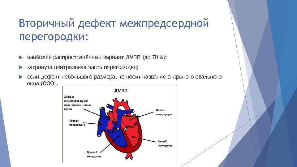 Вторичный дефект межпредсердной перегородки: наиболее распространённый вариант ДМПП (до 70 %); затронута центральная часть