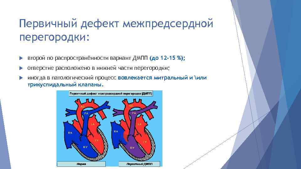 Первичный дефект межпредсердной перегородки: второй по распространённости вариант ДМПП (до 12 -15 %); отверстие