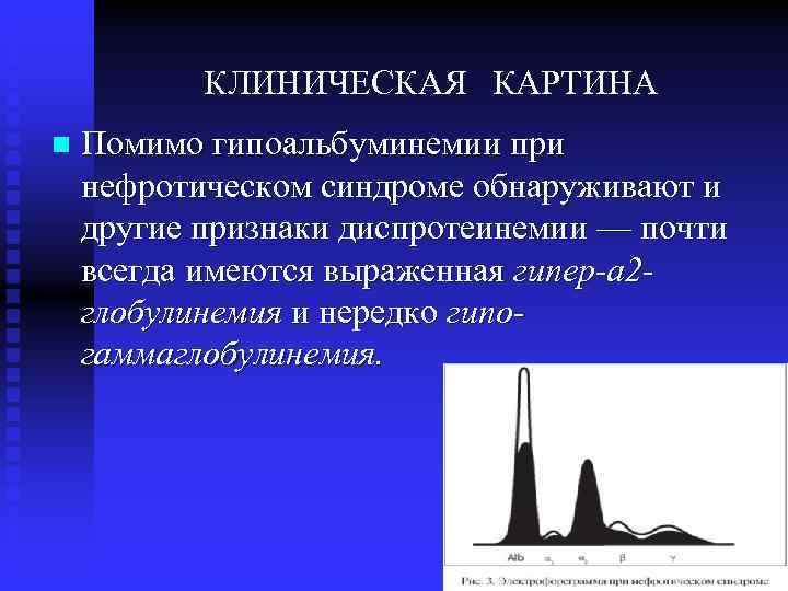 КЛИНИЧЕСКАЯ КАРТИНА n Помимо гипоальбуминемии при нефротическом синдроме обнаруживают и другие признаки диспротеинемии —