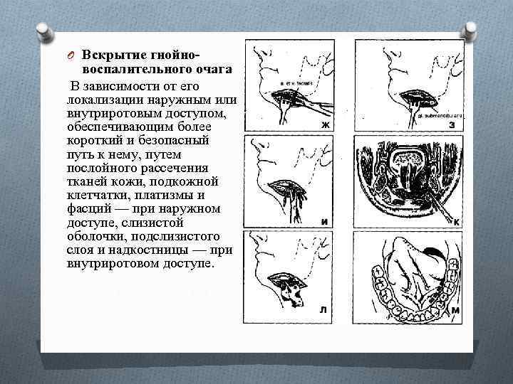 O Вскрытие гнойно- воспалительного очага В зависимости от его локализации наружным или внутриротовым доступом,