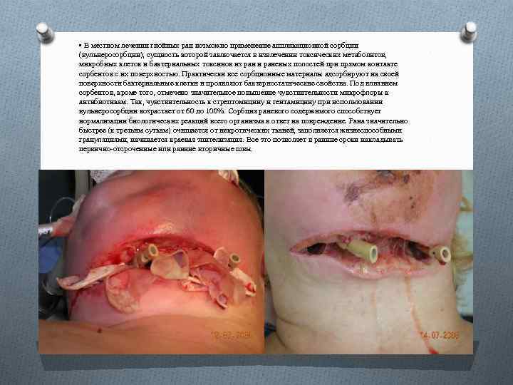  • В местном лечении гнойных ран возможно применение аппликационной сорбции (вульнеросорбции), сущность которой