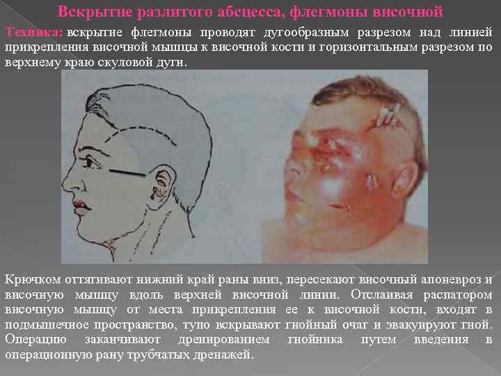 Вскрытие разлитого абсцесса, флегмоны височной Техника: вскрытие флегмоны проводят дугообразным разрезом над линией прикрепления