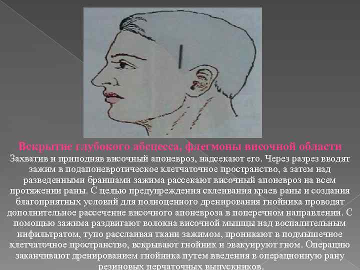 Вскрытие глубокого абсцесса, флегмоны височной области Захватив и приподняв височный апоневроз, надсекают его. Через