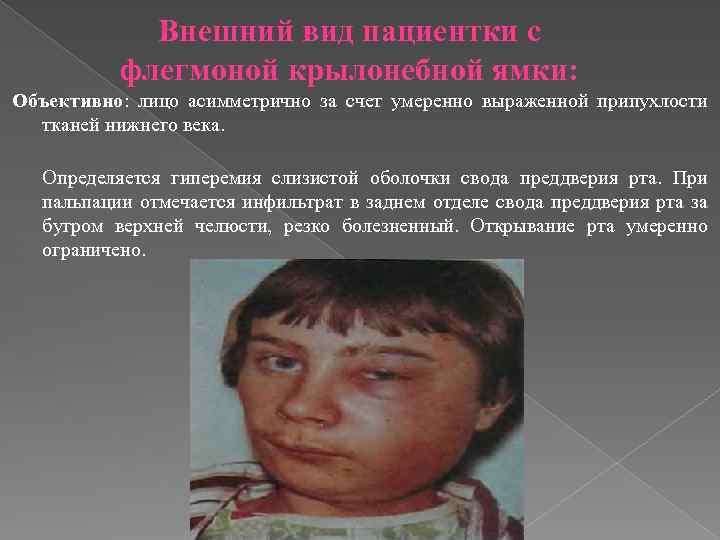 Внешний вид пациентки с флегмоной крылонебной ямки: Объективно: лицо асимметрично за счет умеренно выраженной