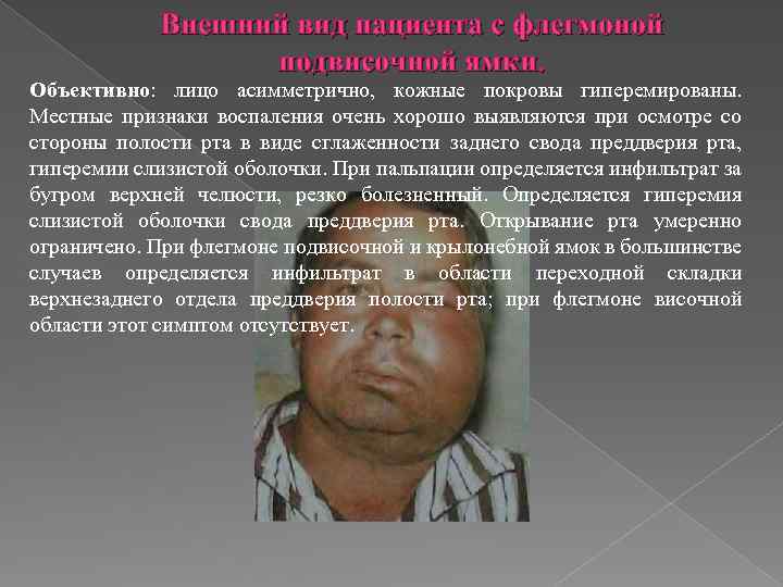 Внешний вид пациента с флегмоной подвисочной ямки. Объективно: лицо асимметрично, кожные покровы гиперемированы. Местные