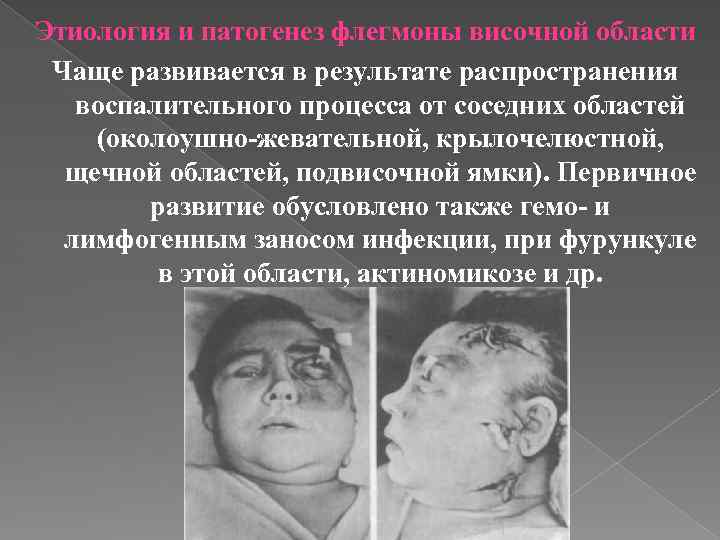 Этиология и патогенез флегмоны височной области Чаще развивается в результате распространения воспалительного процесса от