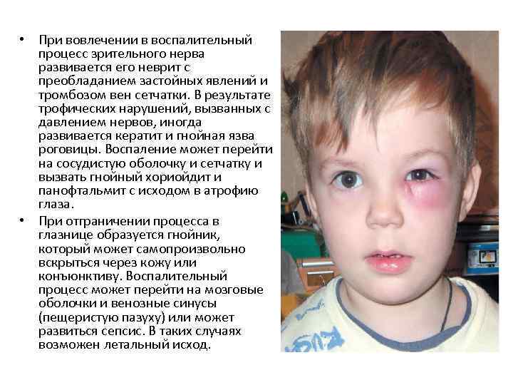  • При вовлечении в воспалительный процесс зрительного нерва развивается его неврит с преобладанием