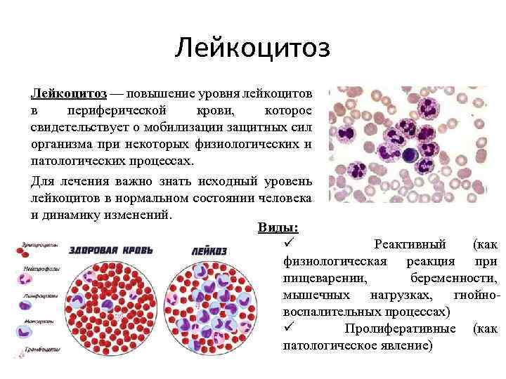 Лейкоцитоз — повышение уровня лейкоцитов в периферической крови, которое свидетельствует о мобилизации защитных сил