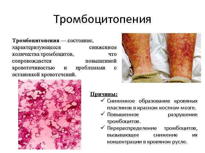 Тромбоцитопения — состояние, характеризующееся снижением количества тромбоцитов, что сопровождается повышенной кровоточивостью и проблемами с