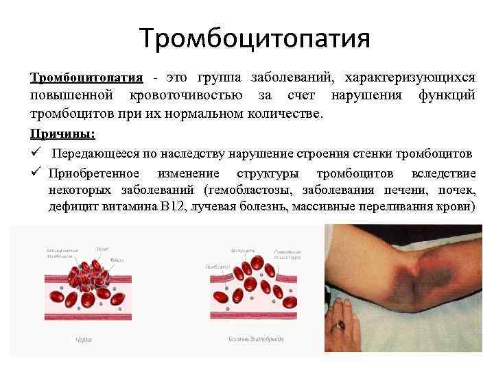 Тромбоцитопатия - это группа заболеваний, характеризующихся повышенной кровоточивостью за счет нарушения функций тромбоцитов при