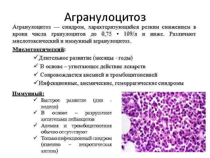 Агранулоцитоз — синдром, характеризующийся резким снижением в крови числа гранулоцитов до 0, 75 •
