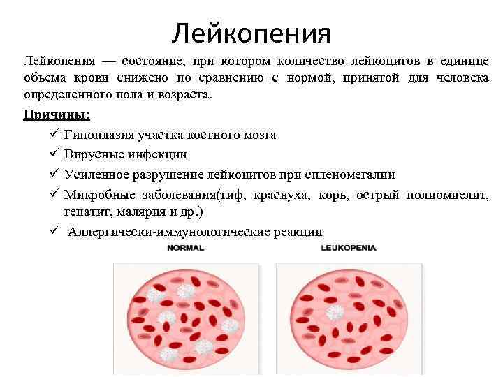 Лейкопения — состояние, при котором количество лейкоцитов в единице объема крови снижено по сравнению