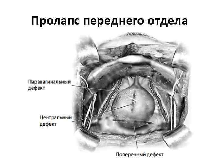 Пролапс переднего отдела 